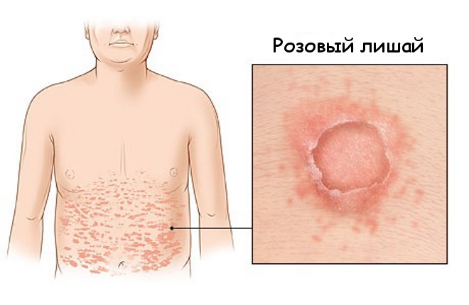 Красные пятна на коже. Аллергия, лишай или ещё что-то? Почему они чешутся. Причины аллергии