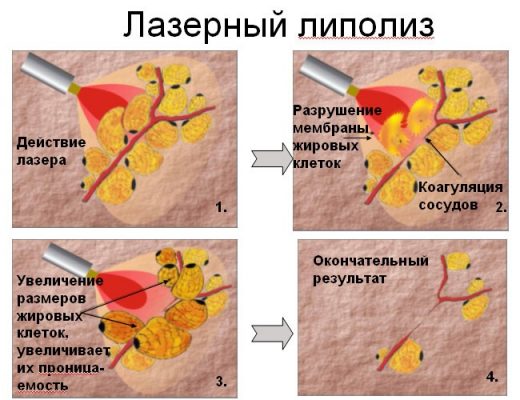 Вдовий горб лечение фото