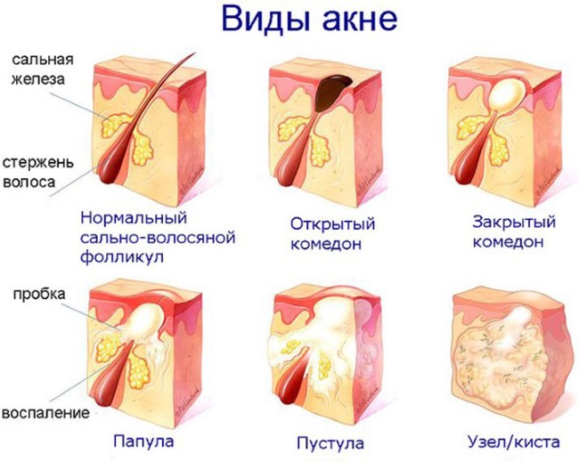 Как избавиться от прыщей на лице, спине, попе, лбу в домашних условиях. Мази, таблетки, народные средства