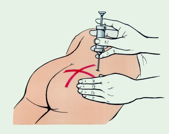 Как правильно делать уколы в ягодицу, попу внутримышечно ребенку, себе. Куда, как поставить, колоть