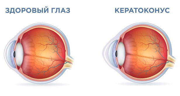 Кератоконус - что это такое, причины, симптомы, способы лечения, операция