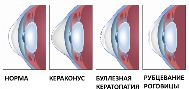 Кератоконус - что это такое, причины, симптомы, способы лечения, операция