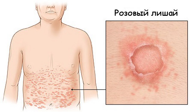 Лишай у взрослого, ребенка. Как лечить розовый, опоясывающий, стригущий, красный, плоский лишай