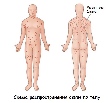 Лишай у взрослого, ребенка. Как лечить розовый, опоясывающий, стригущий, красный, плоский лишай