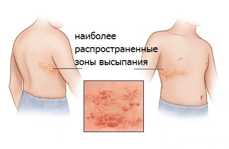 Лишай у взрослого, ребенка. Как лечить розовый, опоясывающий, стригущий, красный, плоский лишай