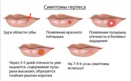 Лишай у взрослого, ребенка. Как лечить розовый, опоясывающий, стригущий, красный, плоский лишай