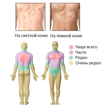 Лишай у взрослого, ребенка. Как лечить розовый, опоясывающий, стригущий, красный, плоский лишай