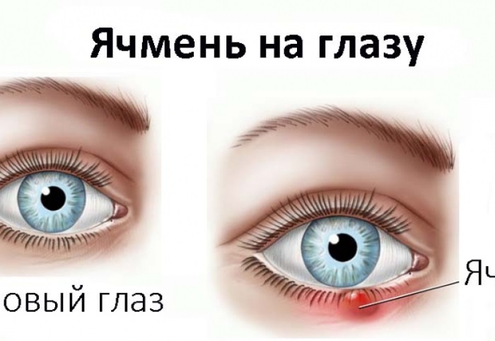 Как быстро вылечить ячмень на глазу у ребенка и взрослого, медикаментозно и народными средствами