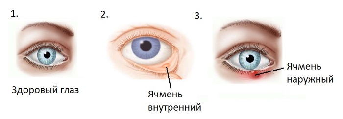 Как быстро вылечить ячмень на глазу у ребенка и взрослого, медикаментозно и народными средствами