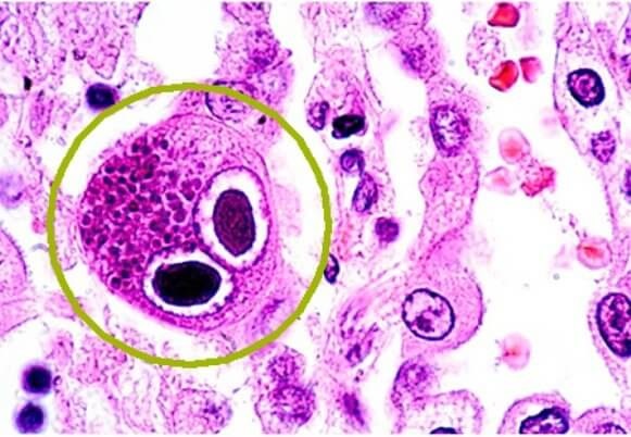 Цитомегаловирус - что это такое у детей, симптомы, как передается инфекция, последствия, лечение