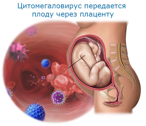 Цитомегаловирус - что это такое у детей, симптомы, как передается инфекция, последствия, лечение