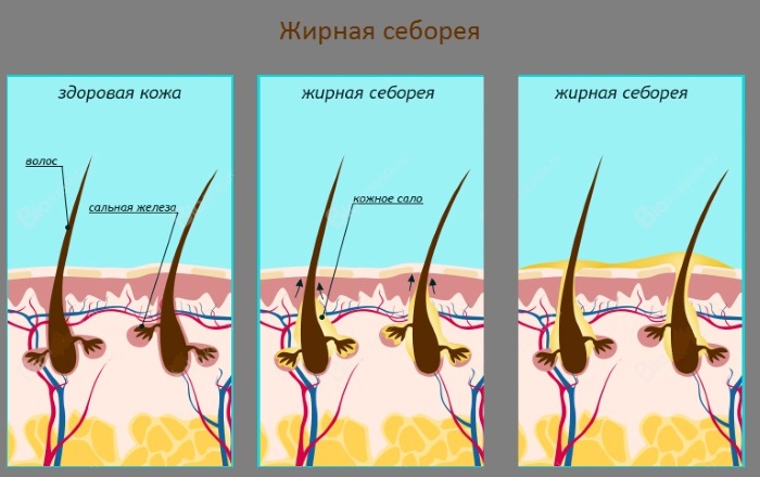 Как избавиться от перхоти навсегда быстро и эффективно в домашних условиях