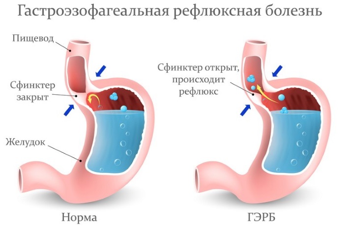 Ком в горле и отрыжка воздухом - причины и лечение