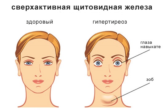 Ком в горле и отрыжка воздухом - причины и лечение