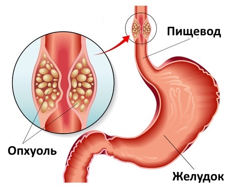 Ком в горле и отрыжка воздухом - причины и лечение