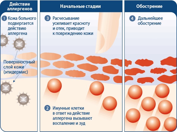 Аллергическая реакция замедленного типа. Типы, виды, стадии, лечение