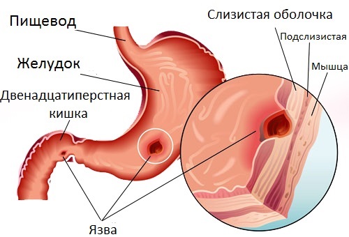 Боль под ребрами с левой, правой стороны, спереди, сбоку, сзади – что это и как лечить