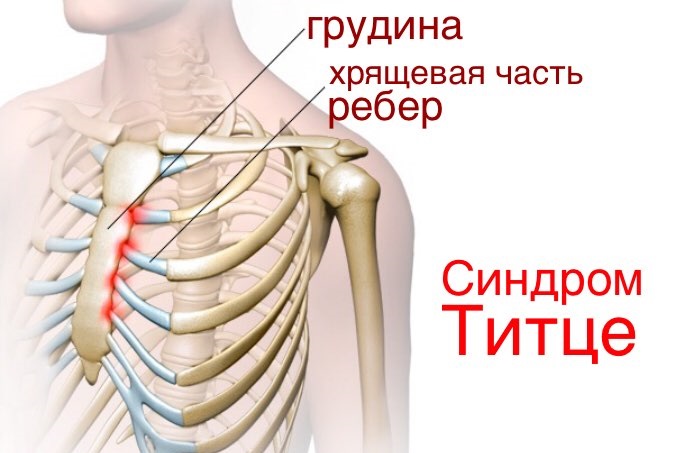 Боль под ребрами с левой, правой стороны, спереди, сбоку, сзади – что это и как лечить