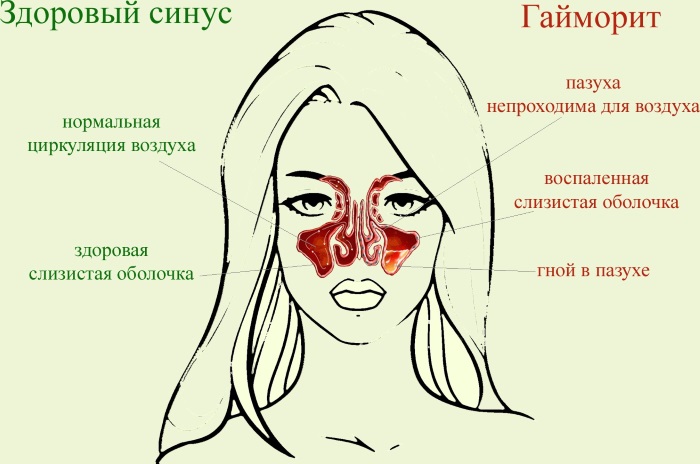 Гайморит - что это такое, симптомы, как лечить народными средствами, лекарственными препаратами у взрослых и детей