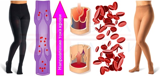 Компрессионные чулки от варикоза вен на ногах: показания к применению, виды, как их подобрать, одевать и носить
