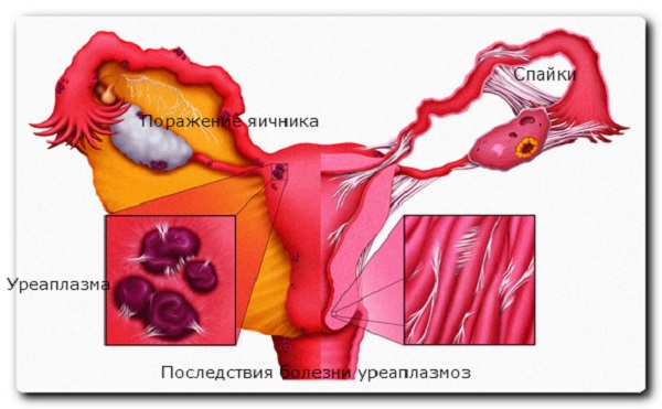 Уреаплазма у женщин - причины, симптомы, схема лечения, препараты, свечи, народные средства