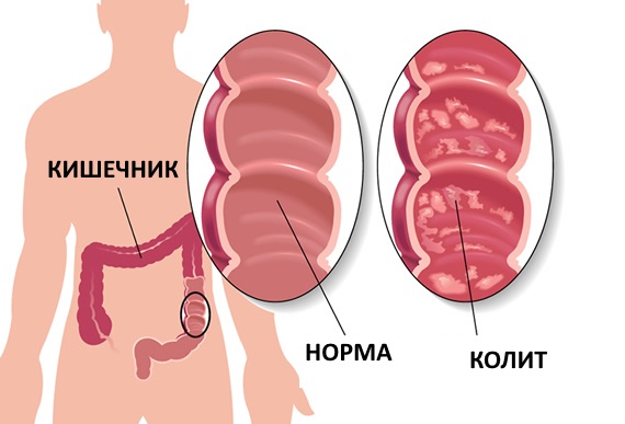 Что можно и нельзя есть при поносе взрослому человеку. Список продуктов