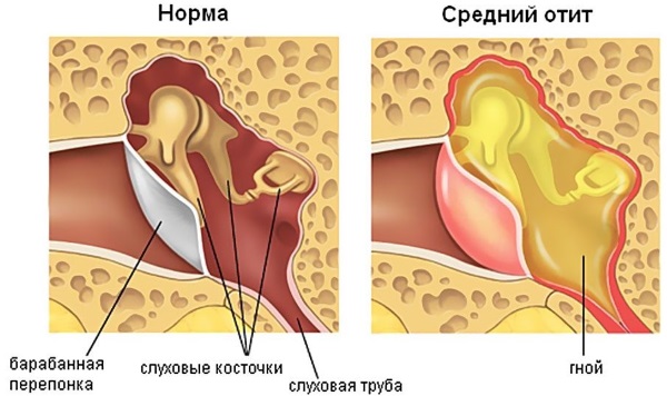 Что делать, если стреляет ухо? Как убрать заложенность, боль и стреляние в домашних условиях