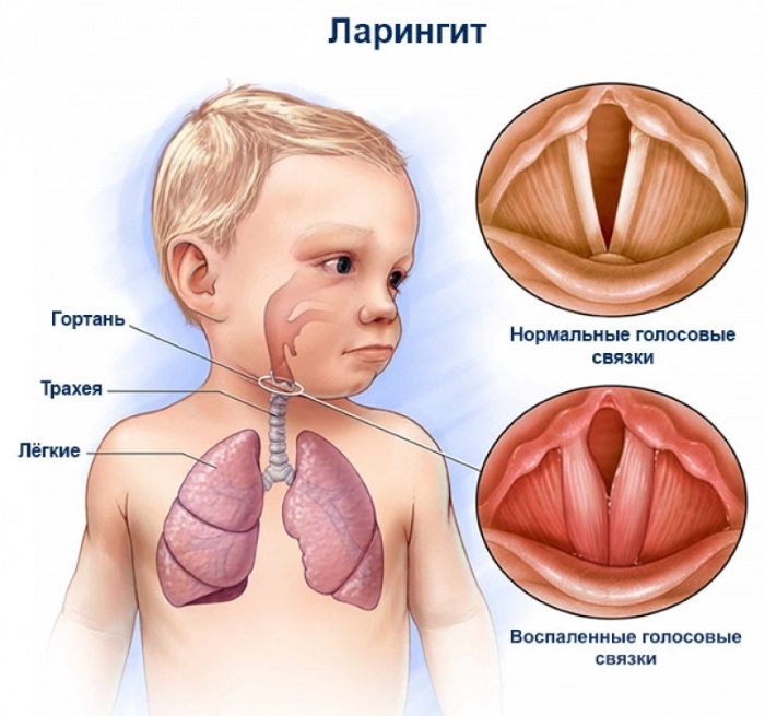 Ларингит у детей. Симптомы, фото и лечение в домашних условиях