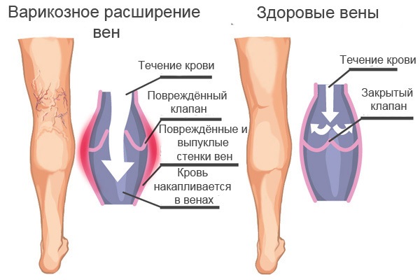 Отекают ноги – причины у женщин, как лечить, одна или обе, при беременности сильных болях, вечером, утром, от сидячей работы. Лечение