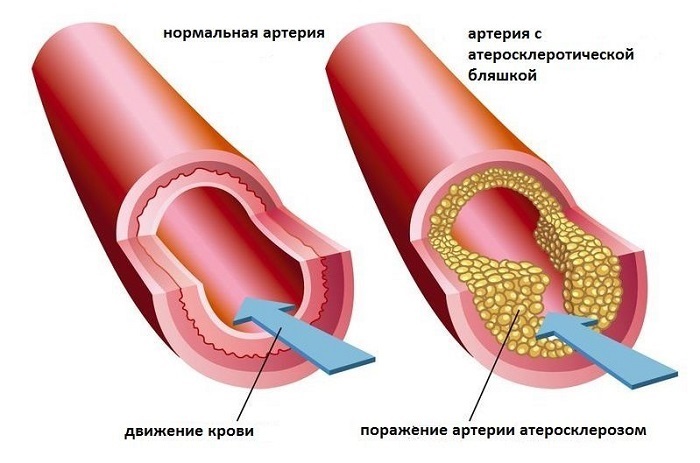 Отекают ноги – причины у женщин, как лечить, одна или обе, при беременности сильных болях, вечером, утром, от сидячей работы. Лечение