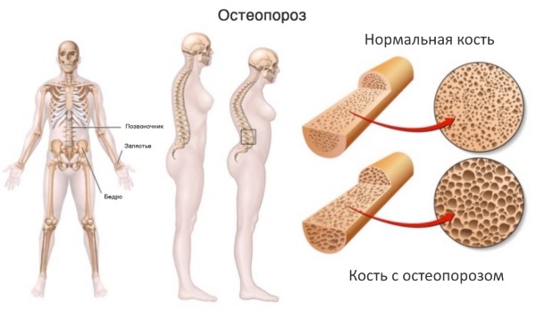 Причины боли в пояснице у женщин, если больно наклоняться, воспалился крестец. Лечение народными средствами