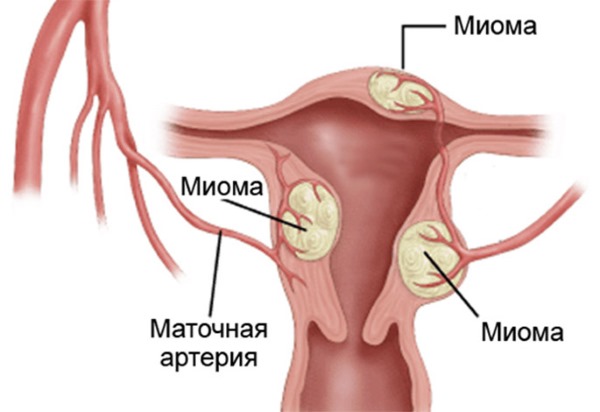 Причины боли в пояснице у женщин, если больно наклоняться, воспалился крестец. Лечение народными средствами