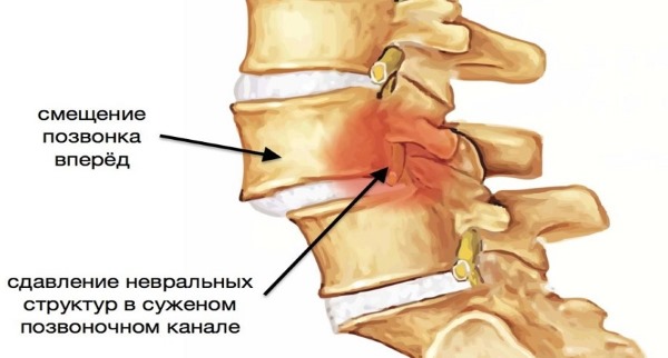 Причины боли в пояснице у женщин, если больно наклоняться, воспалился крестец. Лечение народными средствами