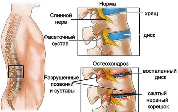 Причины боли в пояснице у женщин, если больно наклоняться, воспалился крестец. Лечение народными средствами