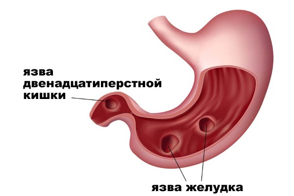 Причины боли в пояснице у женщин, если больно наклоняться, воспалился крестец. Лечение народными средствами