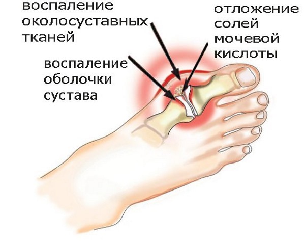 Болит пятка, что это может быть? Диагностика, медикаменты и народные способы лечения