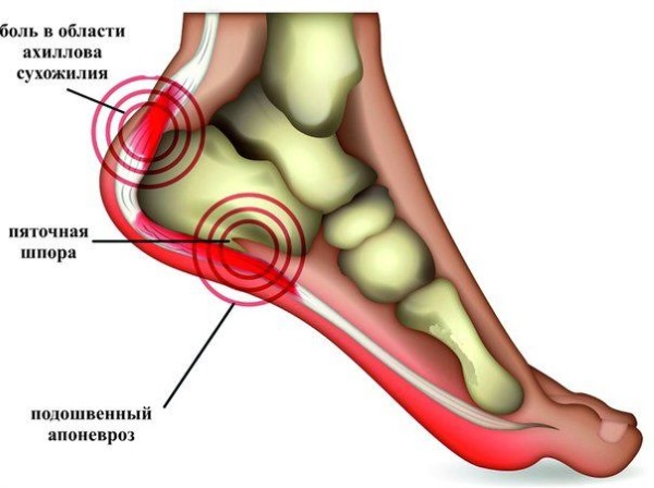 Болит пятка, что это может быть? Диагностика, медикаменты и народные способы лечения