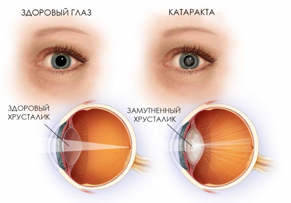 Как лечить катаракту народными средствами без операции: капли, лекарства, упражнения, диета и другие народные методы