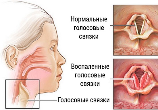 Как быстро восстановить голос при простуде взрослому и ребенку в домашних условиях