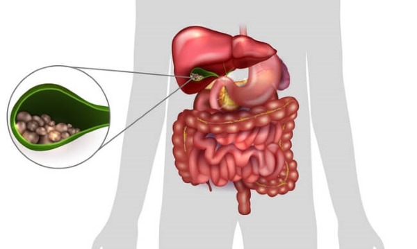 Камни в желчном пузыре - лечение без операции народными средствами, дробление лазером и ультразвуком