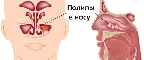 Причины крови из носа у взрослых: по утрам, при нормальном состоянии, часто или внезапно. Первая помощь и лечение патологии