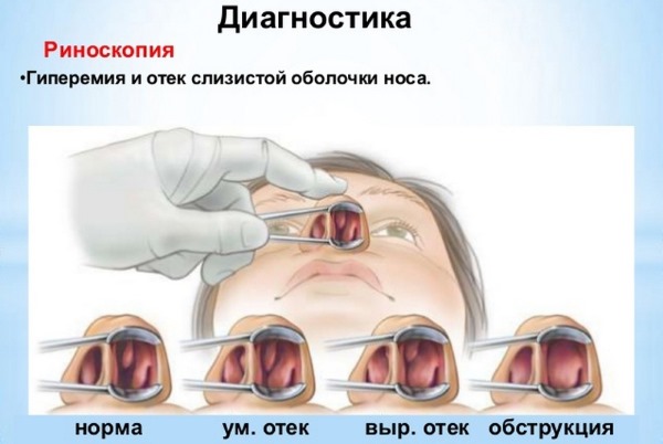 Причины крови из носа у взрослых: по утрам, при нормальном состоянии, часто или внезапно. Первая помощь и лечение патологии