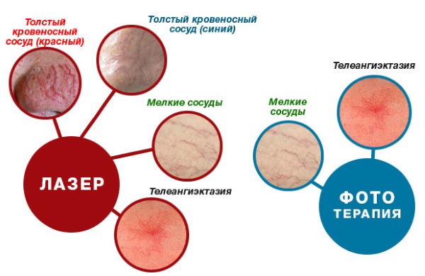 Причины и как лечить купероз на лице. Аптечные препараты, народные способы и рецепты для кожи, косметические процедуры, лазер