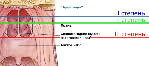 Лечение аденоидов у детей без операции: схема, медикаменты, народные способы, процедуры по удалению