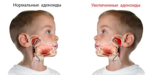 Лечение аденоидов у детей без операции: схема, медикаменты, народные способы, процедуры по удалению