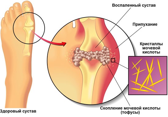 Мочевая кислота в крови: норма по возрасту, таблица симптомов, лечение