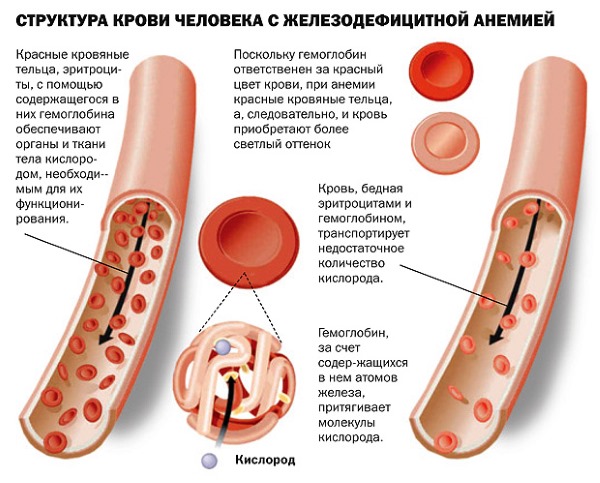 Низкий гемоглобин у женщин: причины, симптомы и последствия. Лечение пониженного уровня гемоглобина