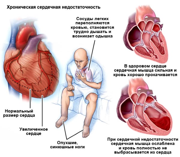 Низкий гемоглобин у женщин: причины, симптомы и последствия. Лечение пониженного уровня гемоглобина