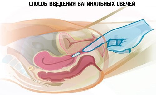 Противовоспалительные свечи в гинекологии для восстановления микрофлоры, при эндометриозе, с календулой, метилурациловые, ихтиоловые. Инструкции по применению