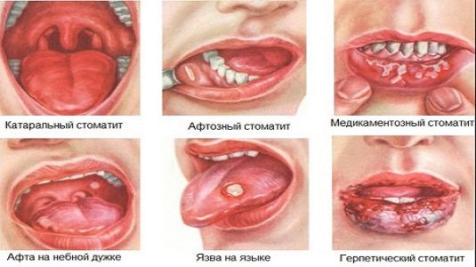 Симптомы и лечение стоматита у детей народными средствами, препаратами, диета